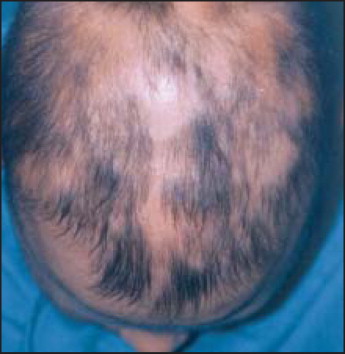 The Underlying Cause Of Hair Loss