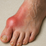 Gout