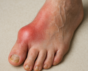 Gout